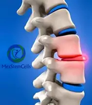 Slider image (10) MexStemCells Clinic
